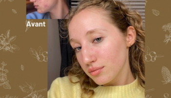Témoignage d'Illiphéa : les cosmétiques FORêT m'ont libéré de mon acné